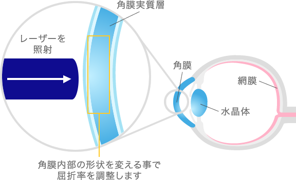 レーザーを使った視力矯正手術図